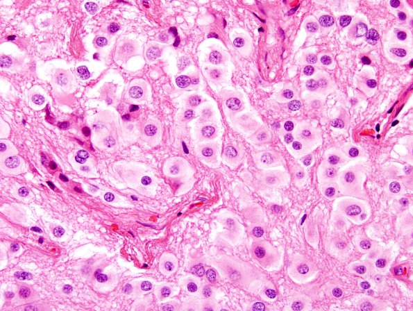 9A3 Pineocytoma w neuronal diffn (Case 9) H&E 3.jpg