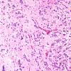 9A4 5Pineocytoma w neuronal diffn (Case 9) H&E 6.jpg