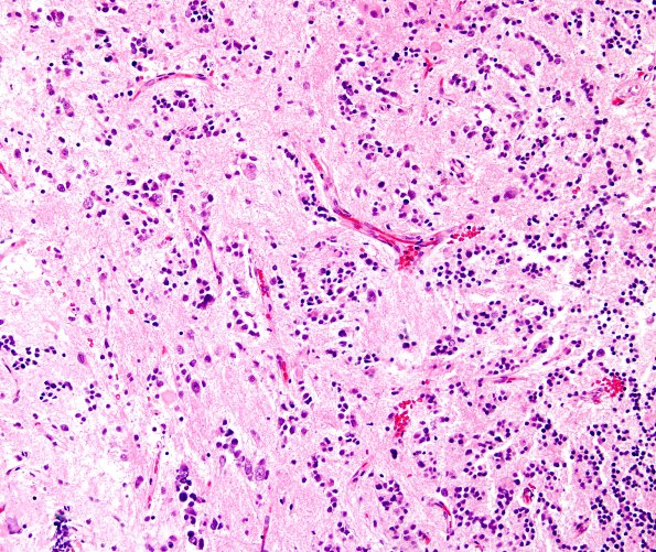 9A4 5Pineocytoma w neuronal diffn (Case 9) H&E 6.jpg