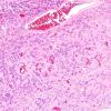 9A5 Pineocytoma w neuronal diffn (Case 9) H&E 13.jpg