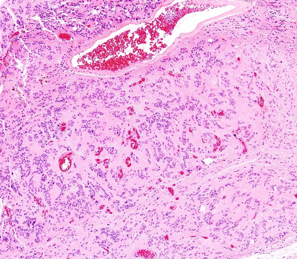 9A5 Pineocytoma w neuronal diffn (Case 9) H&E 13.jpg