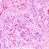 9A6 Pineocytoma w neuronal diffn (Case 9) H&E 14.jpg