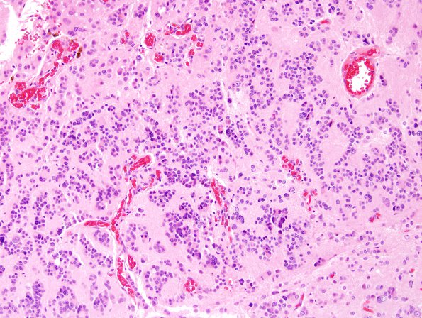 9A6 Pineocytoma w neuronal diffn (Case 9) H&E 14.jpg