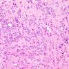 9A7 Pineocytoma w neuronal diffn (Case 9) H&E 7.jpg