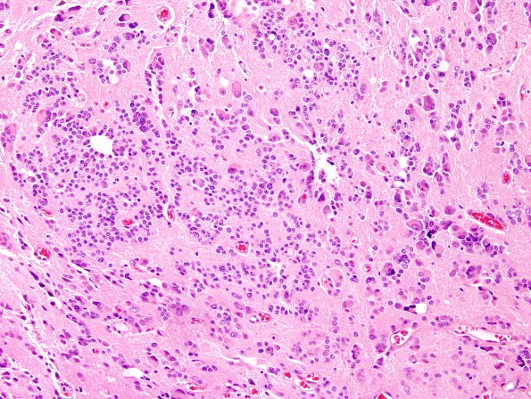 9A7 Pineocytoma w neuronal diffn (Case 9) H&E 7.jpg