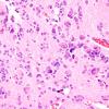 9A8 Pineocytoma w neuronal diffn (Case 9 H&E 8.jpg