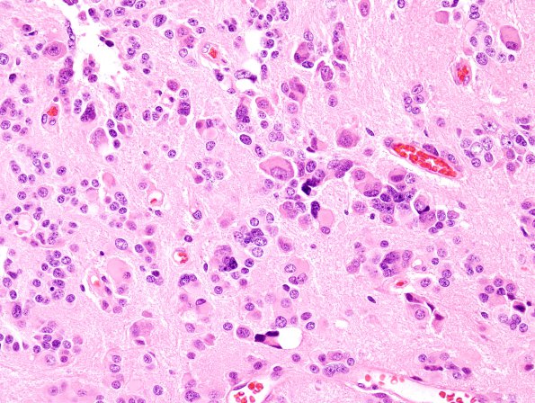 9A8 Pineocytoma w neuronal diffn (Case 9 H&E 8.jpg