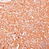 9B1 Pineocytoma w neuronal diffn (Case 9) SYN 9.jpg