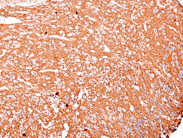 9B1 Pineocytoma w neuronal diffn (Case 9) SYN 9.jpg