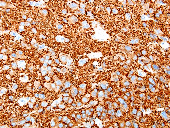 9B2 Pineocytoma w neuronal diffn (Case 9) SYN 2.jpg