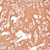 9B3 Pineocytoma w neuronal diffn (Case 9) SYN 4.jpg