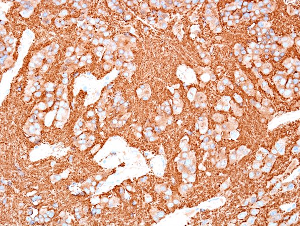 9B3 Pineocytoma w neuronal diffn (Case 9) SYN 4.jpg