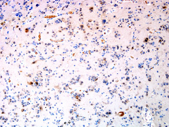 9C1 Pineocytoma w neuronal diffn (Case 9) NeuN 1.jpg