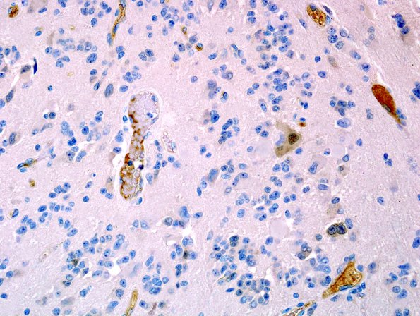 9C3 Pineocytoma w neuronal diffn (Case 9) NeuN 4.jpg