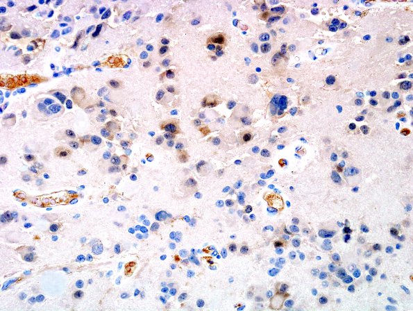 9C4 Pineocytoma w neuronal diffn (Case 9) NeuN 2.jpg