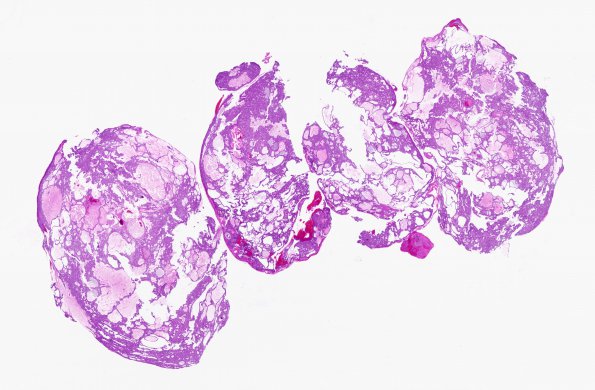 10A1 Craniopharyngioma (Case 10) H&E WM