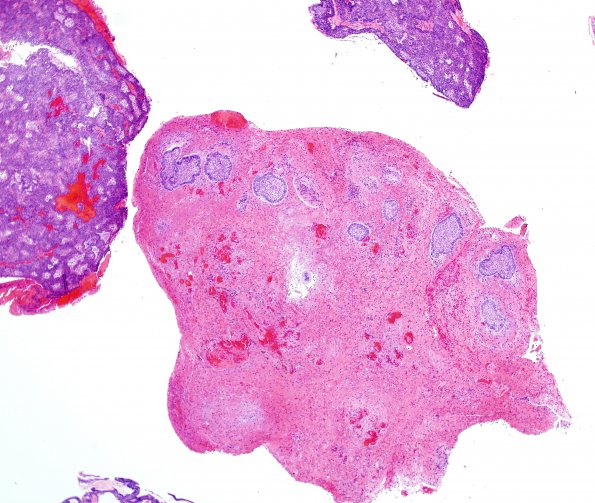 10A2 Craniopharyngioma (Case 10) H&E 18