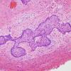 10A4 Craniopharyngioma (Case 10) H&E 13