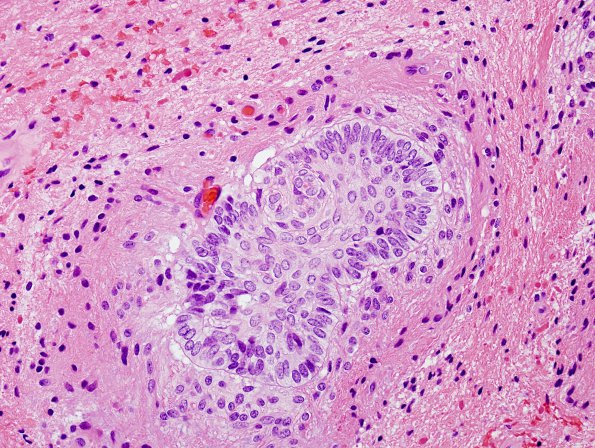 10A5 Craniopharyngioma (Case 10) H&E 16