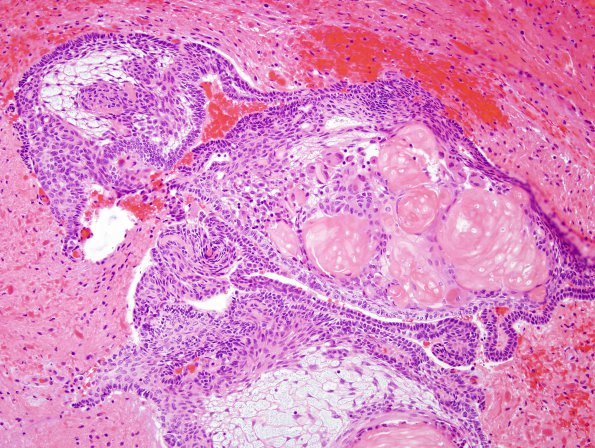 10A7 Craniopharyngioma (Case 10) H&E 6