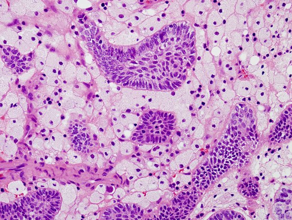 10A8 Craniopharyngioma (Case 10) H&E 15