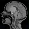 11A1 Craniopharyngioma (Case 11) T1 2 - Copy