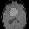 11A2 Craniopharyngioma (Case 11) T1 3 - Copy