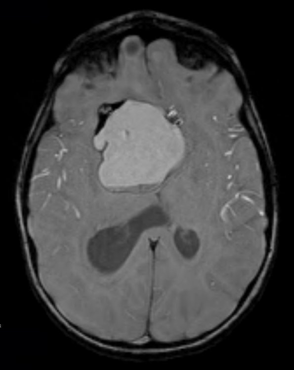 11A2 Craniopharyngioma (Case 11) T1 3 - Copy