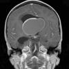 11A3 Craniopharyngioma (Case 11) T1 W - Copy