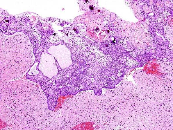 12A1 Craniopharyngioma (Case 12) 9