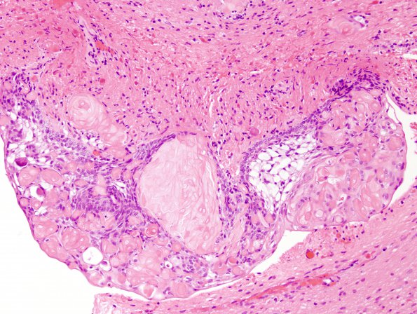 12A2 Craniopharyngioma (Case 12) 7