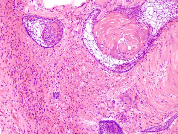 12A3 Craniopharyngioma (Case 12) 3