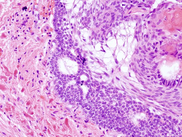 12A4 Craniopharyngioma (Case 12) 5