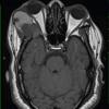 13A1 Craniopharyngioma (Case 13) T1 1 - Copy