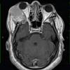 13A2 Craniopharyngioma (Case 13) T1 W 1 - Copy