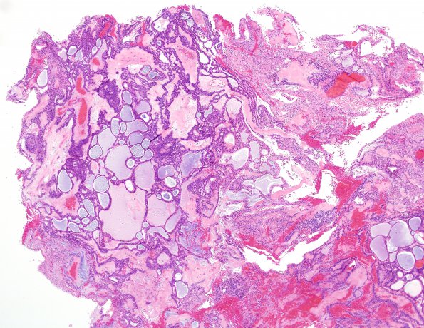 13C1 Craniopharyngioma (Case 13) H&E WM