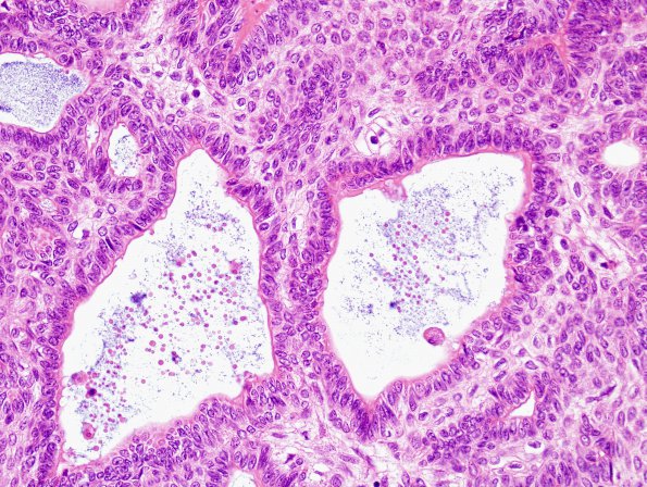 13C3 Craniopharyngioma (Case 13) 7