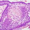 13C4 Craniopharyngioma (Case 13) H&E 1