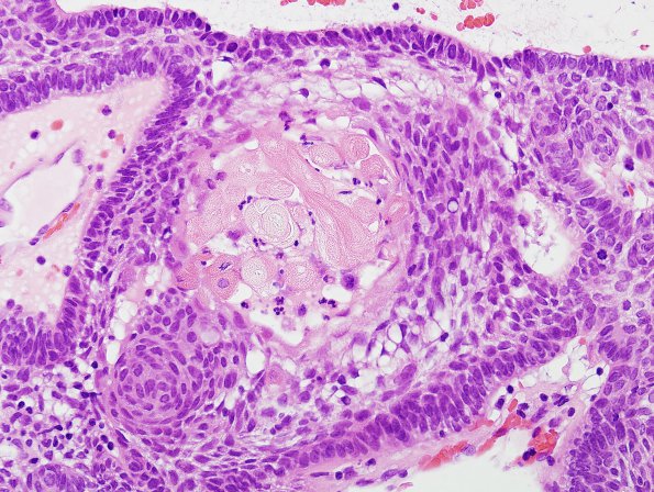 13C4 Craniopharyngioma (Case 13) H&E 1