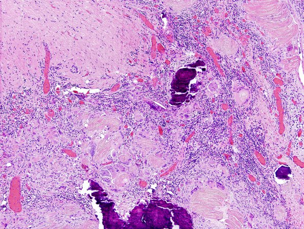 14A1 Cranio SP resection, no live tumor (Case 14) H&E 3.jpg