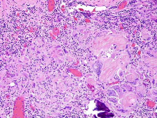 14A2 Cranio SP resection, no live tumor (Case 14) H&E 4.jpg