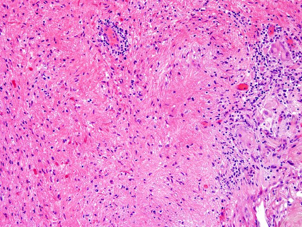 14A4 Cranio SP resection, no live tumor (Case 14) H&E 6.jpg