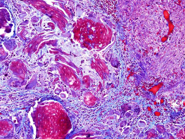 14C1 Cranio SP resection, no live tumor (Case 14) Trichrome 3.jpg