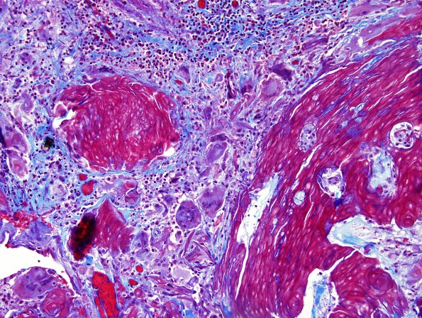 14C2 Cranio SP resection, no live tumor (Case 14) Trichrome 1.jpg