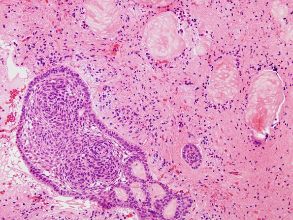 15A1 Craniopharyngioma (Case 15) H&E 3