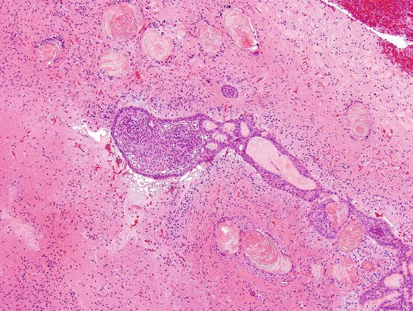 15A2 Craniopharyngioma (Case 15) H&E 2