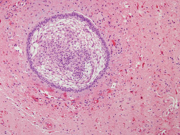 15A3 Craniopharyngioma (Case 15) H&E 1