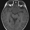 16A2 Craniopharyngioma (Case 16) T1 2 - Copy - Copy