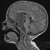 16A3 Craniopharyngioma (Case 16) T1 3 - Copy - Copy