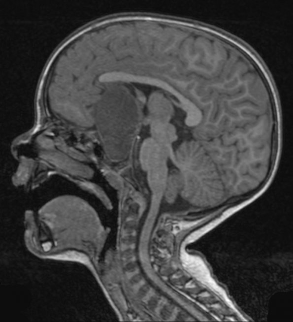 16A3 Craniopharyngioma (Case 16) T1 3 - Copy - Copy